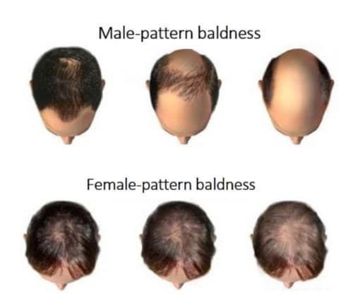 Ottawa Hair Loss Treatment Type