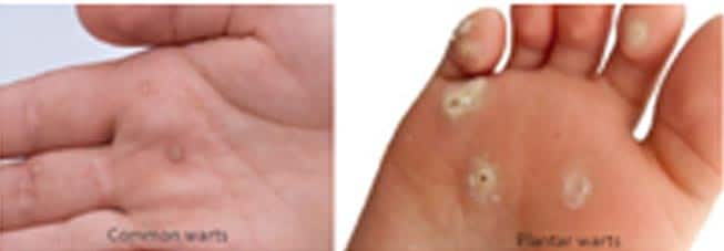 warts removal treatment