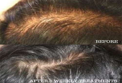 Hair Loss Repair and Vitamin Treatment